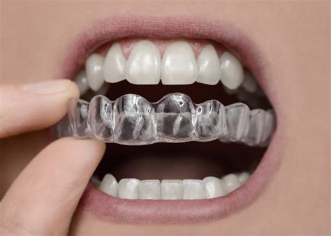 Olympia wa invisalign  Gone are the days where the only option is to endure wire braces to improve your smile